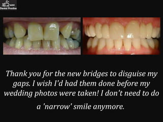 Thank you for the new bridges to disguise my
  gaps. I wish I'd had them done before my
wedding photos were taken! I don't need to do
         a 'narrow' smile anymore.
 