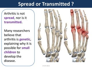 Arthritis is not
spread, nor is it
transmitted.
Many researchers
believe that
arthritis is genetic,
explaining why it is
possible for small
children to
develop the
disease.
Spread or Transmitted ?
27-07-2013
 