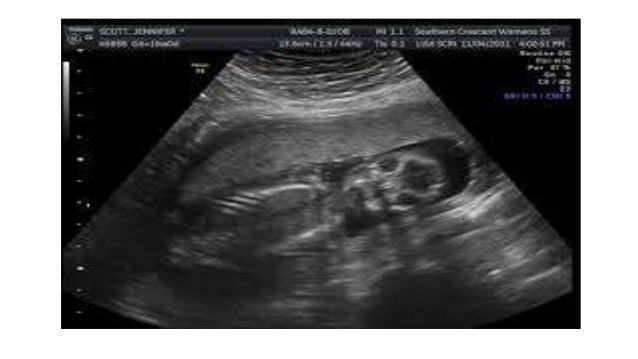 low amniotic fluid at 20 week ultrasound low amniotic fluid at 20 week ultrasound
