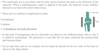 • The metal pads act as two plates and the body tissues between the pads as the dielectric of the
capacitor. When a radiofrequency output is applied to the pads, the dielectric losses manifest
themselves as heat in the intervention tissue.
• There are two methods of application of pads:
Contraplanar
Coplanar
1: Contraplanar electrode placement
• In this type of arrangement, the two electrodes are placed in two different planes, this is why it
is called as contraplanar. The placement is such that the two pads sandwich the treating body
part between them.
• Let us take knee joint as an example, the two pads are placed on the two sides of the knee as
shown in the figure below.
 