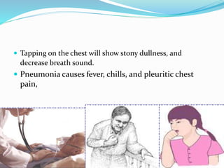  Tapping on the chest will show stony dullness, and
decrease breath sound.
 Pneumonia causes fever, chills, and pleuritic chest
pain,
 