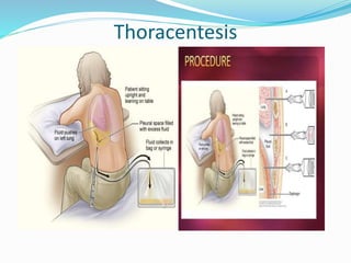 Thoracentesis
 