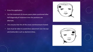 • Cross-fire application:
• For the treatment of sinuses,space plates positioned after
half diagonally,of treatment time the positions are
alternate.
• this ensures that the all the sinses membranesare heated.
• Care must be taken to avoid direct placement over the eye
uterinedisorders such as dysmenrrohea.
 