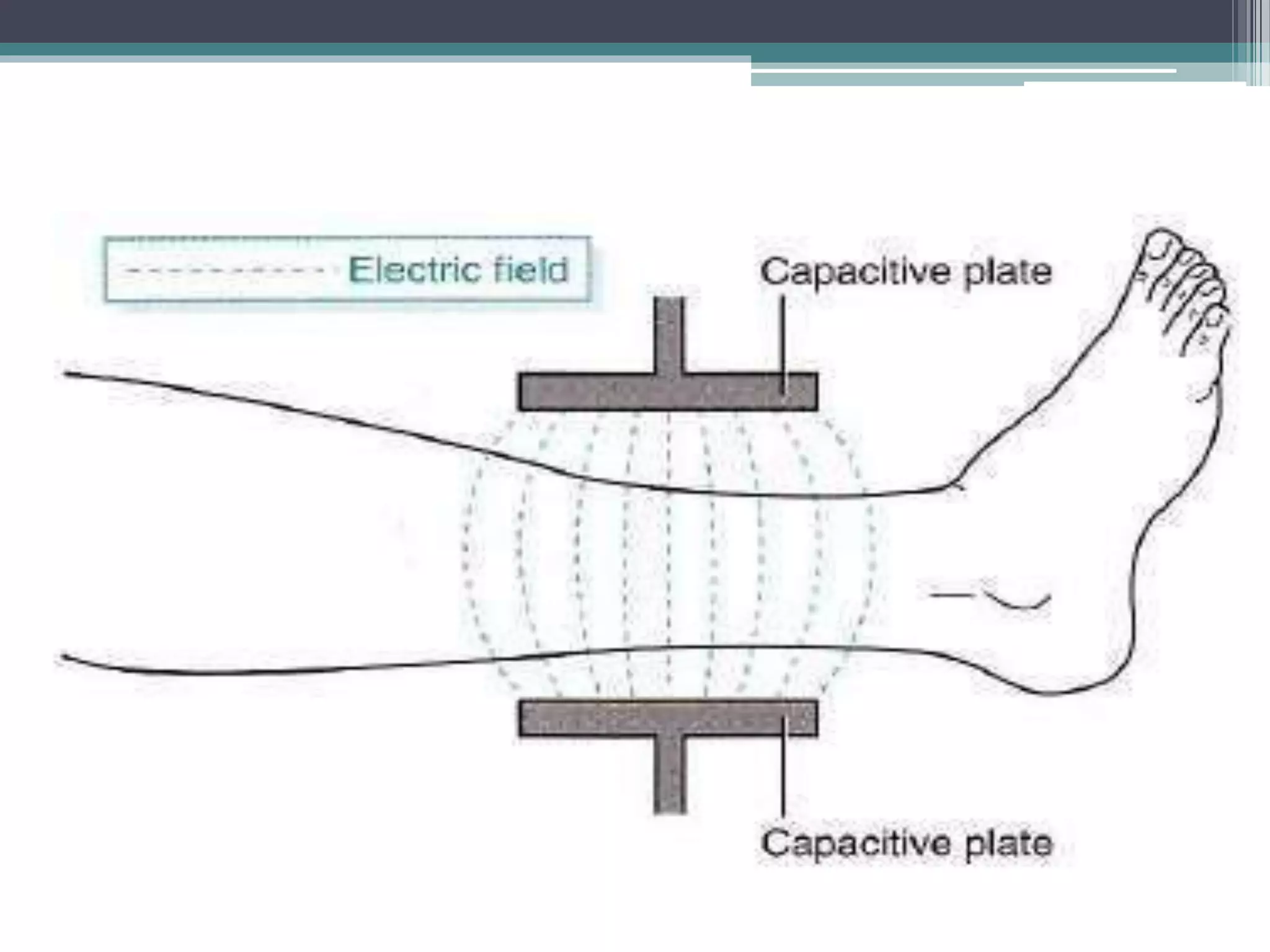 SHORT WAVE DIATHERMY (SWD) | PPTX