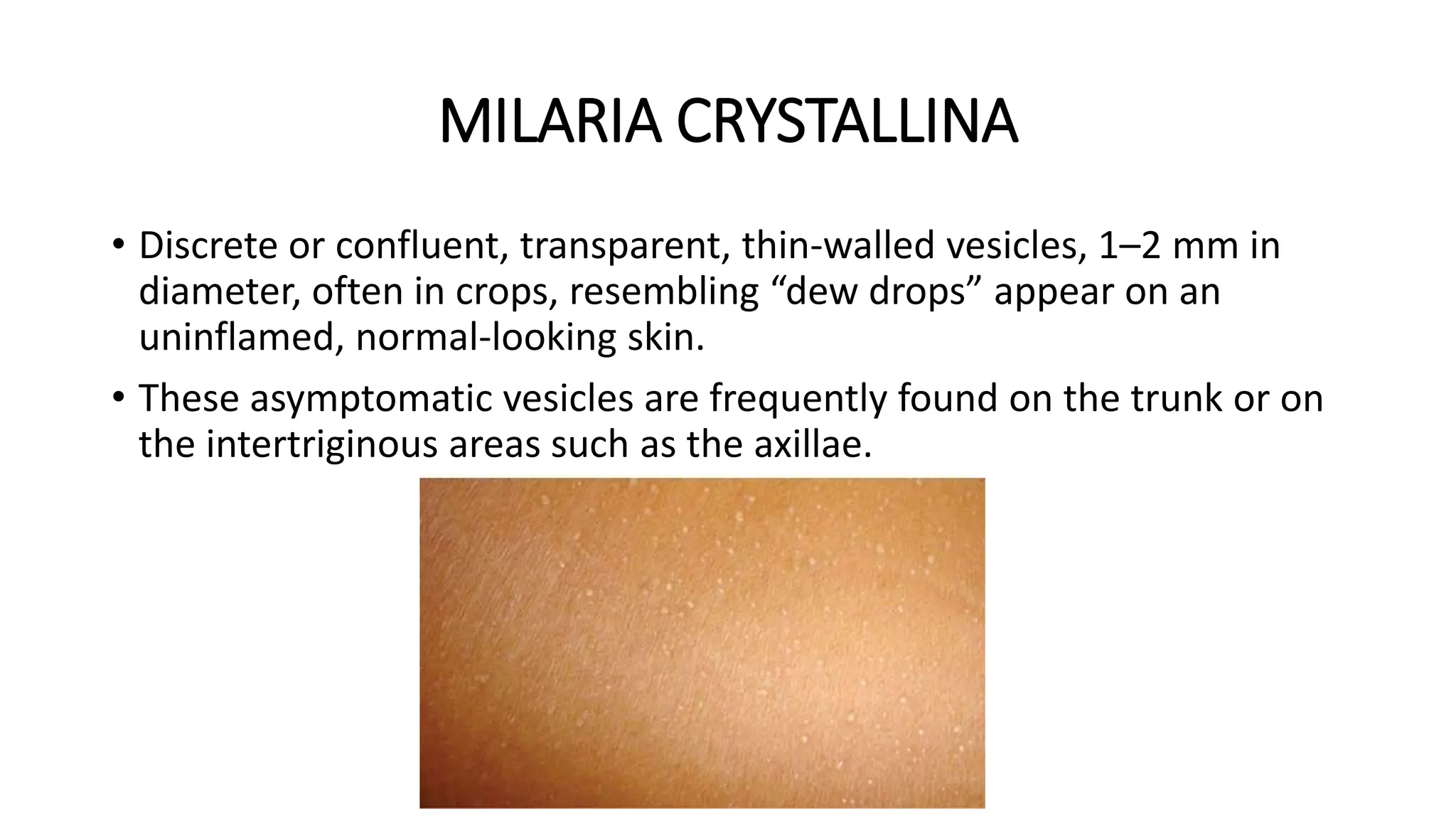 MILARIA CRYSTALLINA
• Discrete or confluent, transparent, thin-walled vesicles, 1–2 mm in
diameter, often in crops, resembling “dew drops” appear on an
uninflamed, normal-looking skin.
• These asymptomatic vesicles are frequently found on the trunk or on
the intertriginous areas such as the axillae.
 