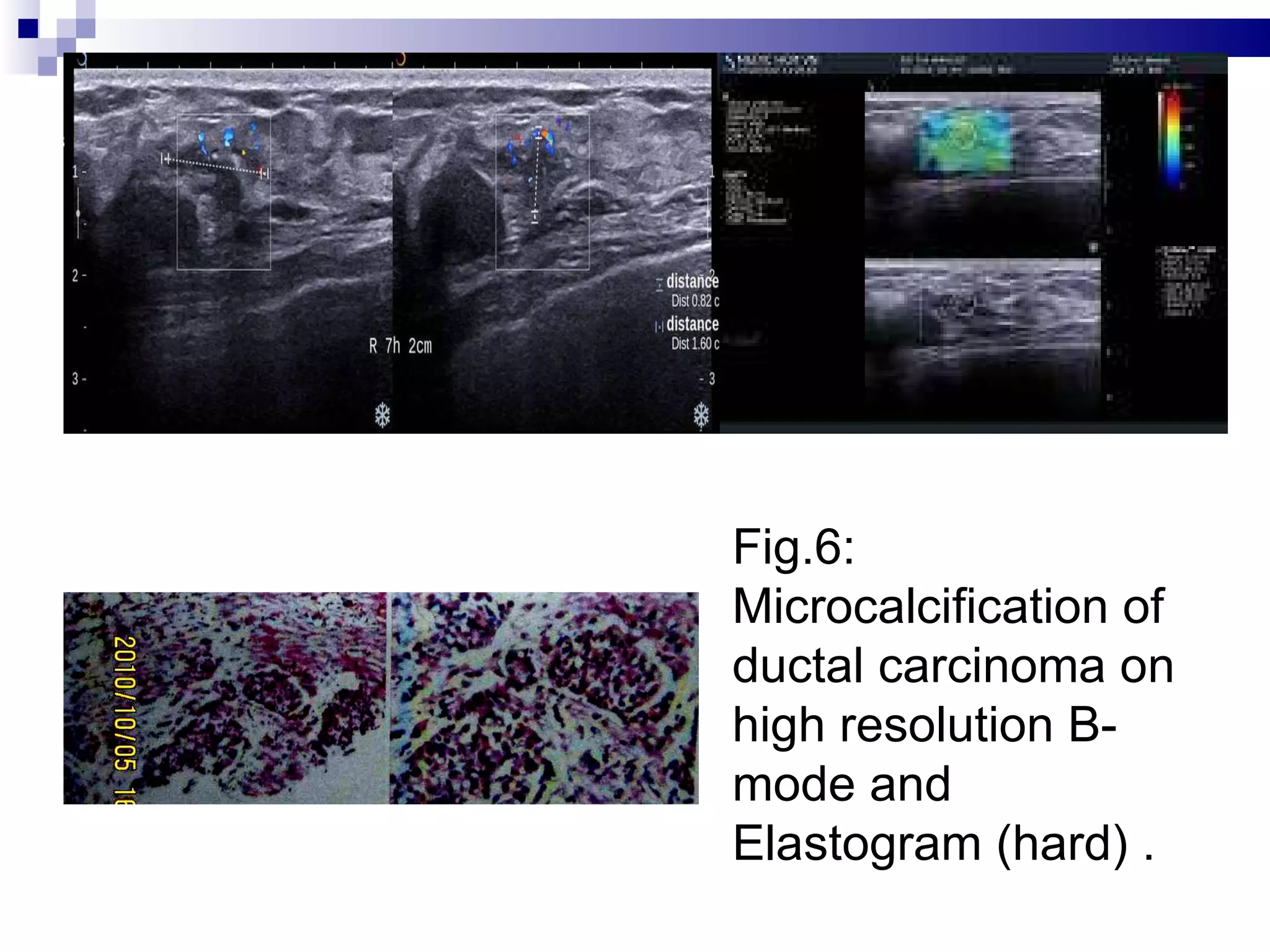 SHEAR WAVE ELASTOGRAPHY of BREAST TUMORS | PPT