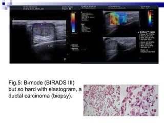 SHEAR WAVE ELASTOGRAPHY of BREAST TUMORS | PPT