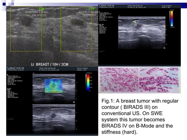 SHEAR WAVE ELASTOGRAPHY of BREAST TUMORS | PPT