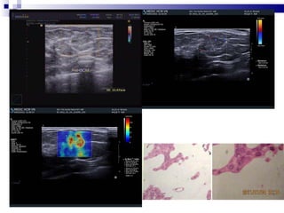 SHEAR WAVE ELASTOGRAPHY of BREAST TUMORS | PPT