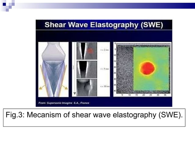 SHEAR WAVE ELASTOGRAPHY of BREAST TUMORS | PPT