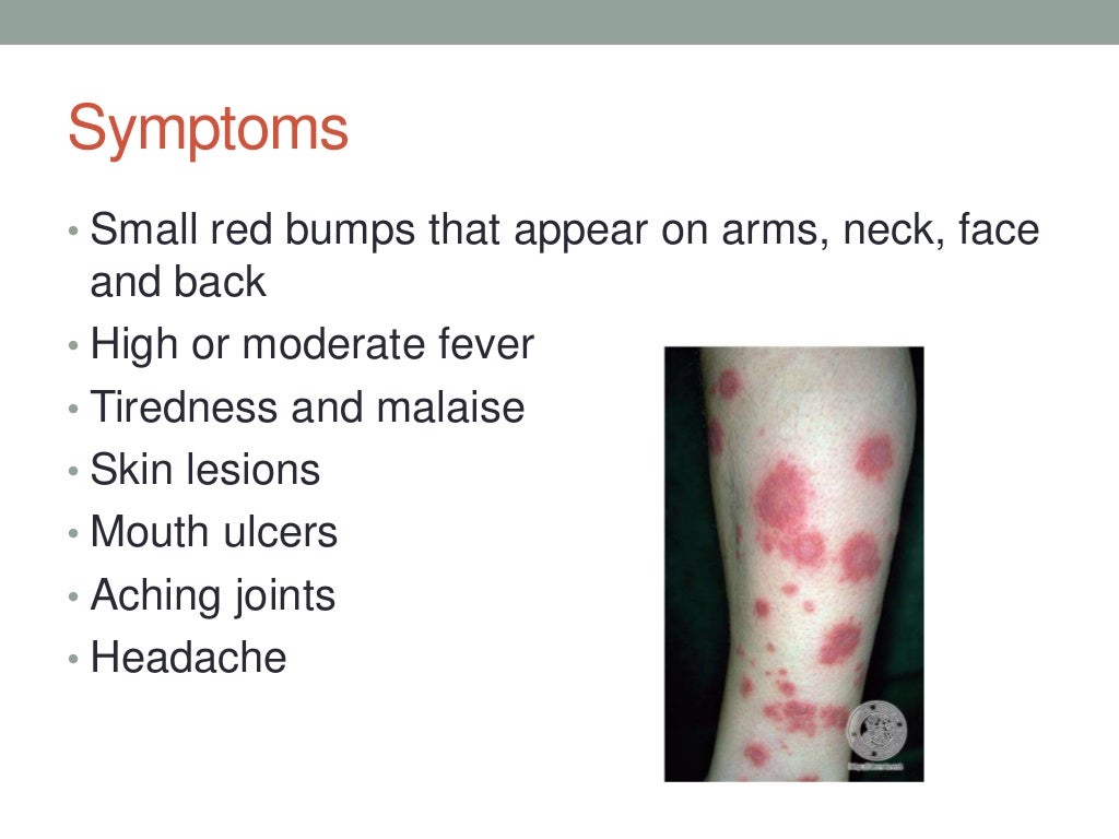 Sweet's syndrome