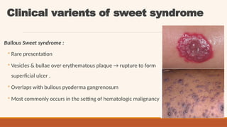 Comprehensive Overview of Sweet Syndrome: Pathogenesis, Clinical ...