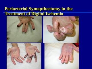 Periarterial Symapthectomy in thePeriarterial Symapthectomy in the
Treatment of Digital IschemiaTreatment of Digital Ischemia
 