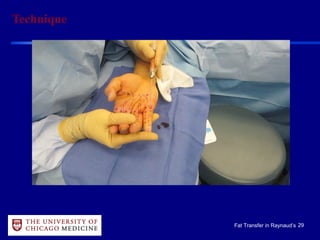 29Fat Transfer in Raynaud’s
Technique
 