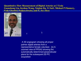 Quantitative Flow Measurement of Digital Arteries at 3 TeslaQuantitative Flow Measurement of Digital Arteries at 3 Tesla
Guanzhong Liu, Kezhou Wang, Xinjian Du, Yi Sui1, Michael P Flannery,Guanzhong Liu, Kezhou Wang, Xinjian Du, Yi Sui1, Michael P Flannery,
Fady Charbel, Nadera Sweiss, and X. Joe ZhouFady Charbel, Nadera Sweiss, and X. Joe Zhou
a
)
b
)
A 3D angiogram showing all proper
palmer digital arteries from a
representative female volunteer. (b) A
zoomed view of PPDA2 showing the
automatically determined perpendicular
plane for the subsequent 2D PC
acquisition
 