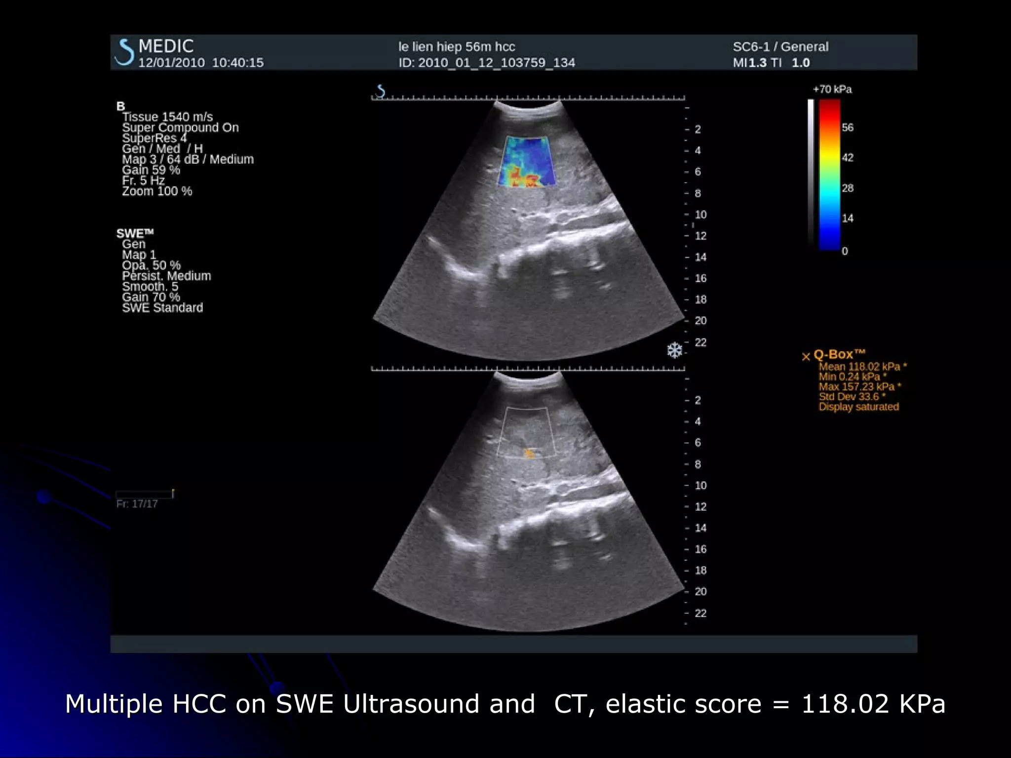 SHEAR WAVE ELASTOGRAPHY of LIVER TUMORS | PPT