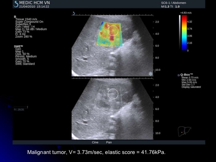 SHEAR WAVE ELASTOGRAPHY of LIVER TUMORS