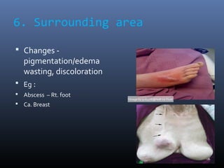 6. Surrounding area
 Changes -
pigmentation/edema
wasting, discoloration
 Eg :
 Abscess – Rt. foot
 Ca. Breast
*Image ...