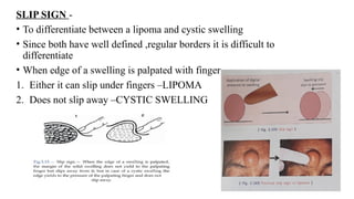 Slipped Sign EXAMINATION of swellings of the oral cavity | PPTX