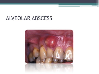 Swellings of the jaw | PPTX