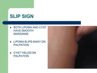 Slipped Sign Clinical examination of swelling | PDF