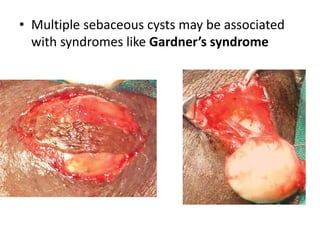 • Multiple sebaceous cysts may be associated
with syndromes like Gardner’s syndrome
 