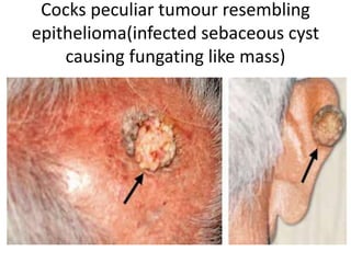 Cocks peculiar tumour resembling
epithelioma(infected sebaceous cyst
causing fungating like mass)
 