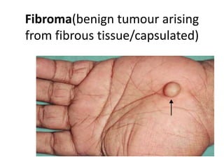 Fibroma(benign tumour arising
from fibrous tissue/capsulated)
 
