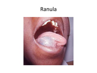 Ranula
 