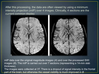 After this processing, the data are often viewed by using a minimum
 intensity projection (mIP) over 4 images. Clinically, 4 sections are the
 current common display




mIP data over the original magnitude images (A) and over the processed SWI
images (B). The mIP is carried out over 7 sections (representing a 14-mm slab
thickness).
The images were collected at 3T. There is a dropout of signal intensity in the frontal
part of the brain, but otherwise the vessel visibility is much improved in B
 