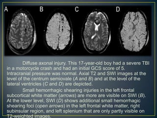 Diffuse axonal injury. This 17-year-old boy had a severe TBI
in a motorcycle crash and had an initial GCS score of 5.
Intracranial pressure was normal. Axial T2 and SWI images at the
level of the centrum semiovale (A and B) and at the level of the
lateral ventricles (C and D) are depicted.
         Small hemorrhagic shearing injuries in the left frontal
subcortical white matter (arrows) are more are visible on SWI (B).
At the lower level, SWI (D) shows additional small hemorrhagic
shearing foci (open arrows) in the left frontal white matter, right
subinsular region, and left splenium that are only partly visible on
T2-weighted images.
 