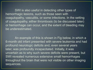 SWI is also useful in detecting other types of
hemorrhagic lesions, such as those seen with
coagulopathy, vasculitis, or some infections. In the setting
of coagulopathy, either thrombosis (to be discussed later)
or hemorrhage can occur, and the extent of bleeding may
be underestimated.

        An example of this is shown in Fig below, in which a
6-month old infant presented with severe leukemia and had
profound neurologic deficits and, even several years
later, was profoundly incapacitated. Initially, it was
uncertain as to why such severe deficits were present, but
SWI revealed numerous extensive small hemorrhages
throughout the brain that were not visible on other imaging
sequences.
 