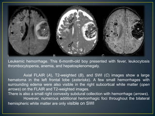 Leukemic hemorrhage. This 6-month-old boy presented with fever, leukocytosis
thrombocytopenia, anemia, and hepatosplenomegaly.

         Axial FLAIR (A), T2-weighted (B), and SWI (C) images show a large
hematoma in the left frontal lobe (asterisks). A few small hemorrhages with
surrounding edema were also visible in the right subcortical white matter (open
arrows) on the FLAIR and T2-weighted images.
There is also a small right convexity subdural collection with hemorrhage (arrows).
         However, numerous additional hemorrhagic foci throughout the bilateral
hemispheric white matter are only visible on SWI
 