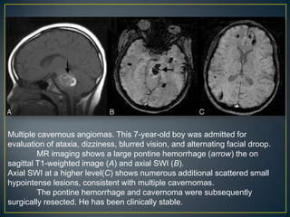 Multiple cavernous angiomas. This 7-year-old boy was admitted for
evaluation of ataxia, dizziness, blurred vision, and alternating facial droop.
         MR imaging shows a large pontine hemorrhage (arrow) the on
sagittal T1-weighted image (A) and axial SWI (B).
Axial SWI at a higher level(C) shows numerous additional scattered small
hypointense lesions, consistent with multiple cavernomas.
         The pontine hemorrhage and cavernoma were subsequently
surgically resected. He has been clinically stable.
 