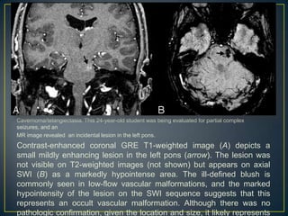 Cavernoma/telangiectasia. This 24-year-old student was being evaluated for partial complex
seizures, and an
MR image revealed an incidental lesion in the left pons.
Contrast-enhanced coronal GRE T1-weighted image (A) depicts a
small mildly enhancing lesion in the left pons (arrow). The lesion was
not visible on T2-weighted images (not shown) but appears on axial
SWI (B) as a markedly hypointense area. The ill-defined blush is
commonly seen in low-flow vascular malformations, and the marked
hypointensity of the lesion on the SWI sequence suggests that this
represents an occult vascular malformation. Although there was no
pathologic confirmation, given the location and size, it likely represents
 