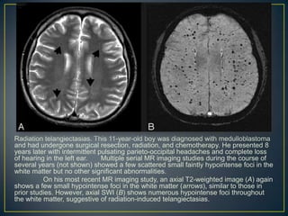 Radiation telangiectasias. This 11-year-old boy was diagnosed with medulloblastoma
and had undergone surgical resection, radiation, and chemotherapy. He presented 8
years later with intermittent pulsating parieto-occipital headaches and complete loss
of hearing in the left ear.    Multiple serial MR imaging studies during the course of
several years (not shown) showed a few scattered small faintly hypointense foci in the
white matter but no other significant abnormalities.
          On his most recent MR imaging study, an axial T2-weighted image (A) again
shows a few small hypointense foci in the white matter (arrows), similar to those in
prior studies. However, axial SWI (B) shows numerous hypointense foci throughout
the white matter, suggestive of radiation-induced telangiectasias.
 