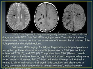 SWS. This 7-year-old boy was originally seen at 18 days of life and
diagnosed with SWS . His first MR imaging scan at 7 months (not shown)
demonstrated intense contrast enhancement of the vascular structures of the
right parietal and occipital regions.
         Follow-up MR imaging. A mildly enlarged deep subependymal vein
along the right lateral ventricle is visible (arrows) on a T2W (A), contrast-
enhanced T1W (B), and SWI (C). The postcontrast T1W (B) also reveals
additional prominently enhancing right subcortical and deep medullary veins
(open arrows). However, SWI (C) best delineates these prominent veins
related to abnormal venous drainage in this condition and also shows a
subtly prominent left subependymal vein (arrowhead), indicating early
 