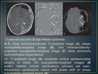 13-year-old boy with Sturge-Weber syndrome.
A–C, Axial contrast-enhanced T1-weighted image (A), phase
susceptibility-weighted image (B), and minimal-intensity-
projection susceptibility-weighted image (C) show prominent
leptomeningeal angiomatosis.
On T1-weighted image (A), moderate cortical parietooccipital
atrophy is noted. On susceptibility-weighted images (B
andC), marked cortical calcifications (arrows) are seen.
Intracortical calcifications induce mild phase shift on phase
 
