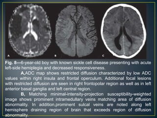 Fig. 8—6-year-old boy with known sickle cell disease presenting with acute
left-side hemiplegia and decreased responsiveness.
         A,ADC map shows restricted diffusion characterized by low ADC
values within right insula and frontal operculum. Additional focal lesions
with restricted diffusion are seen in right frontopolar region as well as in left
anterior basal ganglia and left central region.
         B, Matching minimal-intensity-projection susceptibility-weighted
image shows prominent intramedullary veins matching area of diffusion
abnormality. In addition,prominent sulcal veins are noted along left
hemisphere draining region of brain that exceeds region of diffusion
abnormality.
 