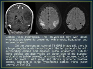 Cortical vein thrombosis. This 16-year-old boy with acute
lymphoblastic leukemia presented with emesis, headache, and
impaired speech.
         On the postcontrast coronal T1-GRE image (A), there is
a large irregular acute hemorrhage in the left parietal lobe with
surrounding edema and adjacent sulcal effacement. Tubular
filling defects are also visible on either side of the superior
sagittal sinus (white arrows), consistent with thrombosed cortical
veins. An axial FLAIR image (B) shows symmetric bilateral
edema, adjacent to large hypointense cortical veins (black
arrows) on SWI (C).
 