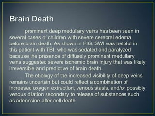 prominent deep medullary veins has been seen in
several cases of children with severe cerebral edema
before brain death. As shown in FIG. SWI was helpful in
this patient with TBI, who was sedated and paralyzed
because the presence of diffusely prominent medullary
veins suggested severe ischemic brain injury that was likely
irreversible and predictive of brain death.
       The etiology of the increased visibility of deep veins
remains uncertain but could reflect a combination of
increased oxygen extraction, venous stasis, and/or possibly
venous dilation secondary to release of substances such
as adenosine after cell death
 