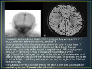 Prominent veins in brain death. This 8-year-old boy was ejected in a
motor vehicle crash and sustained severe TBI
Anteroposterior view of nuclear medicine brain scan 5 days later (A)
demonstrates decreased but not absent cerebral blood flow as
evidenced by activity in the superior sagittal sinus. MR imaging was
obtained 11 days later. Axial SWI (B) shows scattered small
hypointense hemorrhages (arrows) in the subcortical white matter and
corpus callosum, consistent with shearing injuries. In addition, there are
prominent deep medullary veins (open arrows) throughout the bilateral
hemispheres.
He subsequently met clinical criteria for brain death and was taken off
ventilatory support 2 weeks after admission.
 