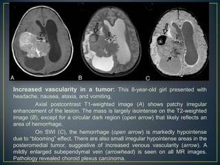 Increased vascularity in a tumor: This 8-year-old girl presented with
headache, nausea, ataxia, and vomiting.
         Axial postcontrast T1-weighted image (A) shows patchy irregular
enhancement of the lesion. The mass is largely isointense on the T2-weighted
image (B), except for a circular dark region (open arrow) that likely reflects an
area of hemorrhage.
         On SWI (C), the hemorrhage (open arrow) is markedly hypointense
due to ―blooming‖ effect. There are also small irregular hypointense areas in the
posteromedial tumor, suggestive of increased venous vascularity (arrow). A
mildly enlarged subependymal vein (arrowhead) is seen on all MR images.
Pathology revealed choroid plexus carcinoma.
 