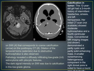 Calcification in
                                                               tumor: This 12-year-
                                                               old girl had a 2-month
                                                               history of intermittent
                                                               headaches, emesis,
                                                               and left
                                                               hemiparesis. Her
                                                               initial CT scan (not
                                                               available) showed
                                                               moderate
                                                               hydrocephalus and a
                                                               fourth-ventricular
                                                               mass. Conventional
                                                               MR imaging images
                                                               (not shown)
on SWI (A) that corresponds to coarse calcification            demonstrated a
(arrow) on the postbiopsy CT (B). Dilation of the              partly cystic and
temporal horns (asterisks) due to obstructive                  partly solid enhancing
hydrocephalus is also observed.                                mass. A smaller
Pathology revealed a diffusely infiltrating low-grade (I-II)   nonenhancing
astrocytoma with pilocytic features.                           heterogeneous
The dark signal intensity on SWI was due to calcification      component in the
                                                               right dorsal pons is
in this low-grade glioma.                                      noted to have a round
 