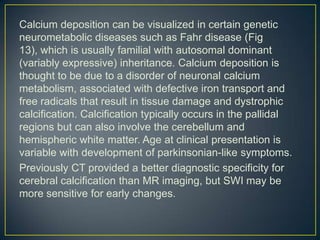 Calcium deposition can be visualized in certain genetic
neurometabolic diseases such as Fahr disease (Fig
13), which is usually familial with autosomal dominant
(variably expressive) inheritance. Calcium deposition is
thought to be due to a disorder of neuronal calcium
metabolism, associated with defective iron transport and
free radicals that result in tissue damage and dystrophic
calcification. Calcification typically occurs in the pallidal
regions but can also involve the cerebellum and
hemispheric white matter. Age at clinical presentation is
variable with development of parkinsonian-like symptoms.
Previously CT provided a better diagnostic specificity for
cerebral calcification than MR imaging, but SWI may be
more sensitive for early changes.
 