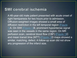 A 46-year-old male patient presented with acute onset of
right hemiparesis for two hours prior to admission.
Diffusion-weighted images showed a small area of
diffusion restriction in the left temporal region [Figure
1]A. On SWI [Figure 1]B, prominent hypointense signal
was seen in the vessels in the same region. On MR
perfusion scan, cerebral blood flow (CBF) [Figure 1]C
and mean transit time (MTT) [Figure 1]D maps showed a
similar, matching, defect. A follow-up scan did not show
any progression of the infarct size.
 