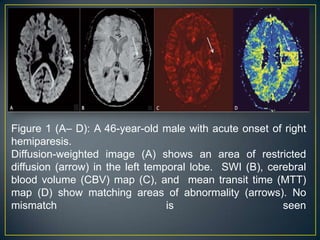 Figure 1 (A– D): A 46-year-old male with acute onset of right
hemiparesis.
Diffusion-weighted image (A) shows an area of restricted
diffusion (arrow) in the left temporal lobe. SWI (B), cerebral
blood volume (CBV) map (C), and mean transit time (MTT)
map (D) show matching areas of abnormality (arrows). No
mismatch                          is                     seen
 