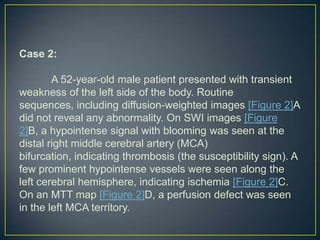 Case 2:

        A 52-year-old male patient presented with transient
weakness of the left side of the body. Routine
sequences, including diffusion-weighted images [Figure 2]A
did not reveal any abnormality. On SWI images [Figure
2]B, a hypointense signal with blooming was seen at the
distal right middle cerebral artery (MCA)
bifurcation, indicating thrombosis (the susceptibility sign). A
few prominent hypointense vessels were seen along the
left cerebral hemisphere, indicating ischemia [Figure 2]C.
On an MTT map [Figure 2]D, a perfusion defect was seen
in the left MCA territory.
 