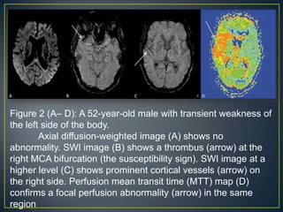Figure 2 (A– D): A 52-year-old male with transient weakness of
the left side of the body.
        Axial diffusion-weighted image (A) shows no
abnormality. SWI image (B) shows a thrombus (arrow) at the
right MCA bifurcation (the susceptibility sign). SWI image at a
higher level (C) shows prominent cortical vessels (arrow) on
the right side. Perfusion mean transit time (MTT) map (D)
confirms a focal perfusion abnormality (arrow) in the same
region
 