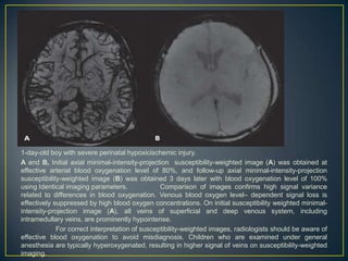 1-day-old boy with severe perinatal hypoxicischemic injury.
A and B, Initial axial minimal-intensity-projection susceptibility-weighted image (A) was obtained at
effective arterial blood oxygenation level of 80%, and follow-up axial minimal-intensity-projection
susceptibility-weighted image (B) was obtained 3 days later with blood oxygenation level of 100%
using Identical imaging parameters.              Comparison of images confirms high signal variance
related to differences in blood oxygenation. Venous blood oxygen level– dependent signal loss is
effectively suppressed by high blood oxygen concentrations. On initial susceptibility weighted minimal-
intensity-projection image (A), all veins of superficial and deep venous system, including
intramedullary veins, are prominently hypointense.
             For correct interpretation of susceptibility-weighted images, radiologists should be aware of
effective blood oxygenation to avoid misdiagnosis. Children who are examined under general
anesthesia are typically hyperoxygenated, resulting in higher signal of veins on susceptibility-weighted
imaging.
 